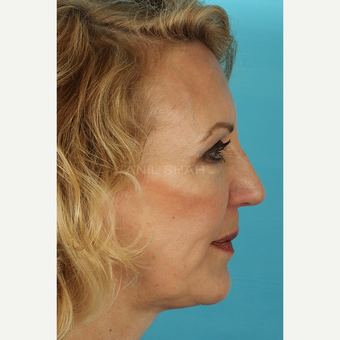 55-64 year old woman treated with Facelift after 3691422