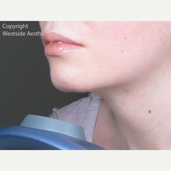 Chin Enhancement before 3065335
