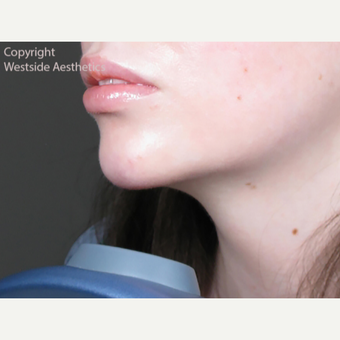 Chin Enhancement after 3065335