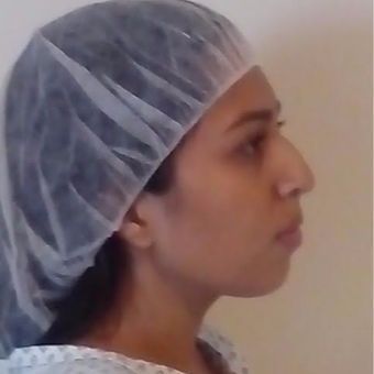 18-24 years old woman rhinoplasty before 3815244