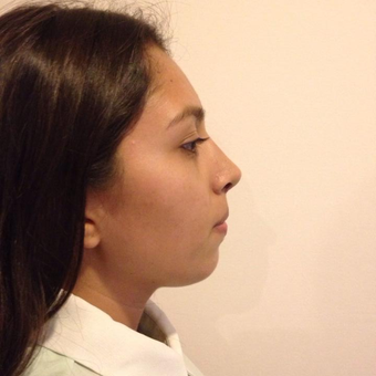 18-24 years old woman rhinoplasty after 3815244
