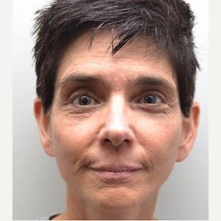 45-54 year old woman treated with Facelift after 3747623