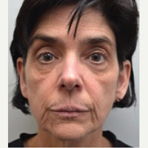 45-54 year old woman treated with Facelift before 3747623