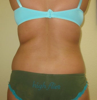 Liposuction of Back, Buttocks and Thighs after 762504