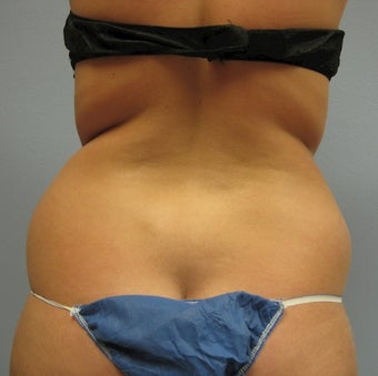 Liposuction of Back, Buttocks and Thighs before 762504
