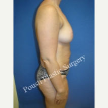 45-54 year old woman treated with Breast Reduction after 3424068