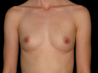 31 year old female - Breast Augmentation - 375 cc before 1079492