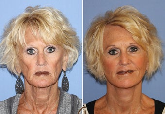 Revision Facelift and Filler before 1344088