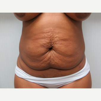 25-34 year old woman treated with Tummy Tuck before 3300059