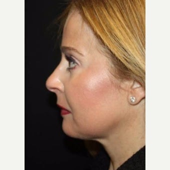 45-54 year old woman treated with Kybella after 2544122