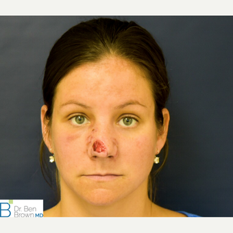 25-34 year old woman who underwent nasal reconstruction after a dog bite to the nose. before 3486790