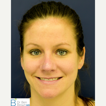 25-34 year old woman who underwent nasal reconstruction after a dog bite to the nose. after 3486790