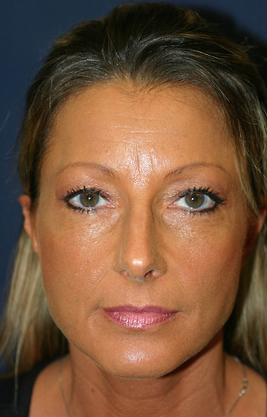 45-54 year old woman treated with Brow Lift before 1675408