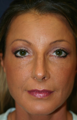 45-54 year old woman treated with Brow Lift after 1675408