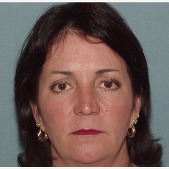 35-44 year old woman treated with Facelift before 1958339