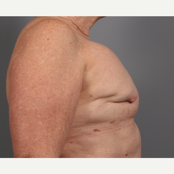65-74 year old woman treated with Breast Reconstruction Revision before 3371057