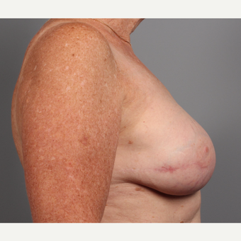 65-74 year old woman treated with Breast Reconstruction Revision after 3371057