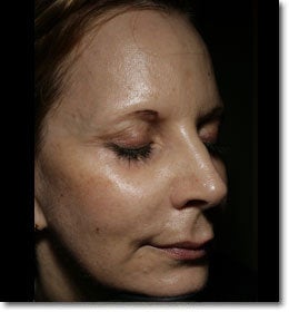 Liquid Facelift after 565991