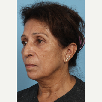 55-64 year old woman treated with Age Spots Treatment after 3321486
