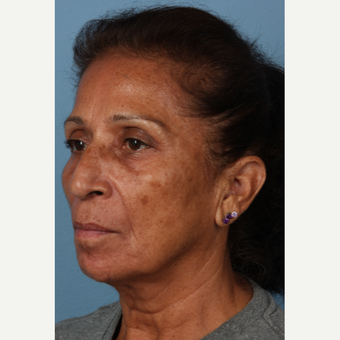 55-64 year old woman treated with Age Spots Treatment before 3321486