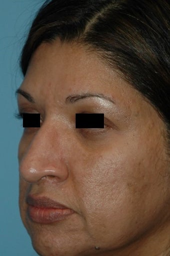 45-54 year old woman treated with Microneedling after 2875641