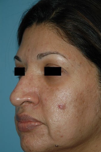 45-54 year old woman treated with Microneedling before 2875641