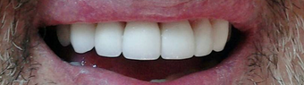 Smile Makeover with zirconium crowns after 1334204