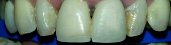 Smile Makeover with zirconium crowns before 1334204