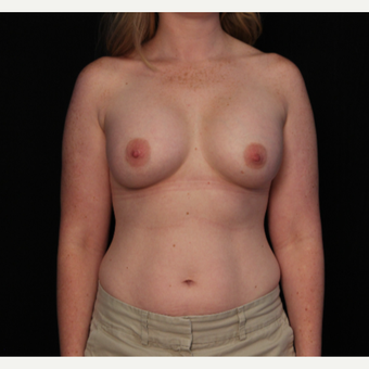 31 year old female with bilateral submuscular silicone implants placed through the underarm after 3522719