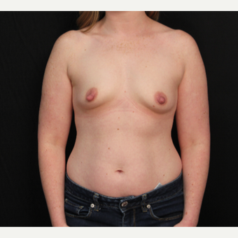 31 year old female with bilateral submuscular silicone implants placed through the underarm before 3522719