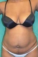 39 year old woman treated with Tummy Tuck before 2327210