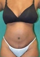 39 year old woman treated with Tummy Tuck after 2327210