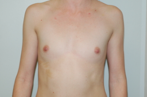 24 year old female underwent Breast augmentation before 3103559