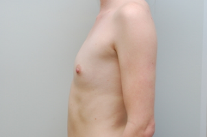 24 year old female underwent Breast augmentation 3103559