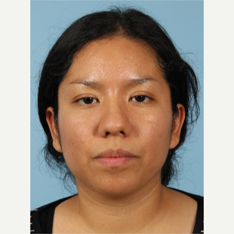 25-34 year old woman treated with Rhinoplasty before 3622636