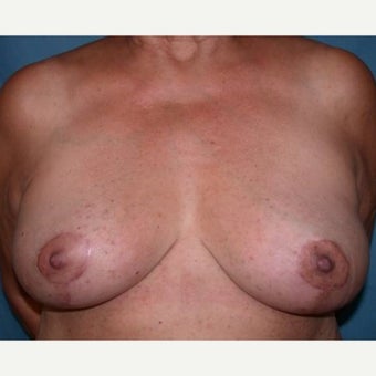 55-64 year old woman treated with Breast Lift after 1581396