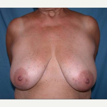 55-64 year old woman treated with Breast Lift before 1581396