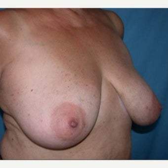 55-64 year old woman treated with Breast Lift 1581396