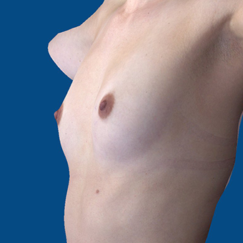 25-34 year old woman treated with Breast Augmentation before 3808700