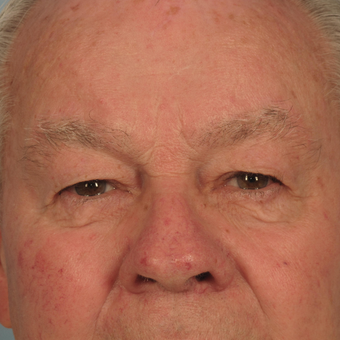 65-74 year old man treated with Eyelid Surgery before 3074735