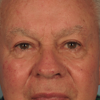 65-74 year old man treated with Eyelid Surgery after 3074735