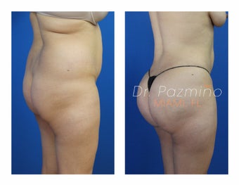 35-44 year old woman treated with Brazilian Butt Lift before 1675735