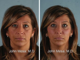 Voluma on midface / cheeks before 1357856