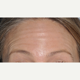 Botox to reduce forehead wrinkles before 3375093
