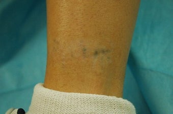 Ankle Tattoo, before, 4 treatments and 11 treatments with 1064 MedLite YAG Laser after 825433