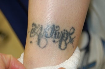 Ankle Tattoo, before, 4 treatments and 11 treatments with 1064 MedLite YAG Laser before 825433