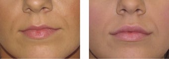 Volbella and Juvederm Lip fillers before 3093700
