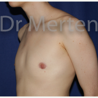18-24 year old man treated with FTM Chest Masculinization Surgery after 3829108