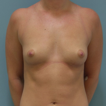 25-34 year old woman treated with Breast Augmentation before 3127885