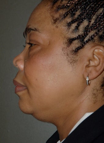 Chin Surgery, Chin Augmentation, Double Chin before 224962